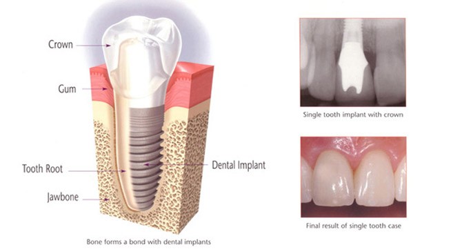 Dental Implants in Pune Dental Implant Procedure
