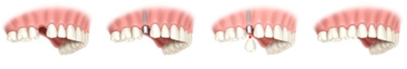Missing One Tooth Missing One Tooth