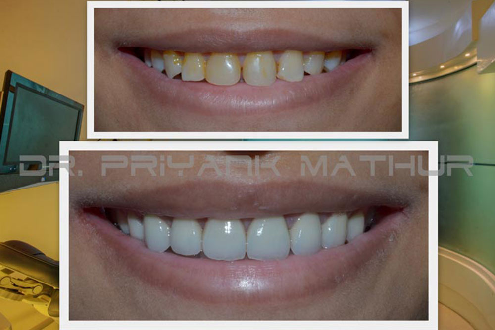 Smile Makeover with 3M LAVA Crowns in Pune Smile Designing in Pune with 3M Lava crowns