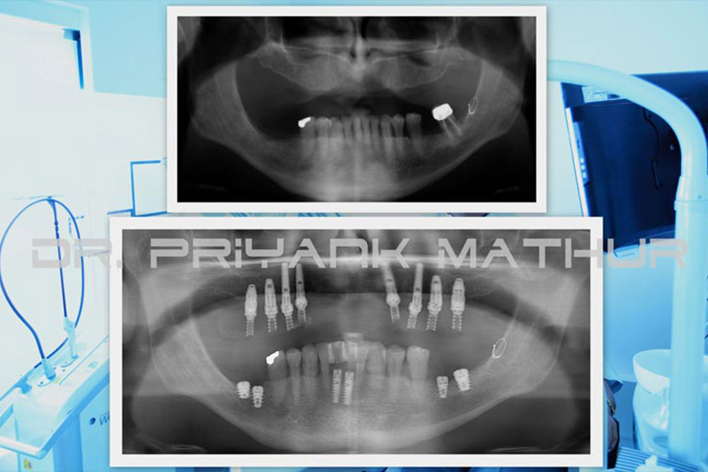 Dental Implants Dental Implants in India