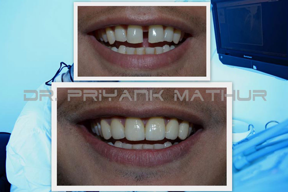 E-Max-Porcelain-Veneers E-Max Porcelain Veneers
