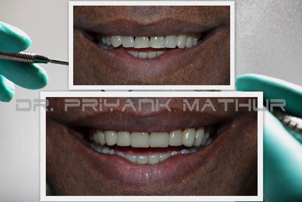 Full-Mouth-Rehabilitation full mouth rehabilitation in Pune
