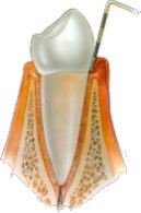 Gingivitis