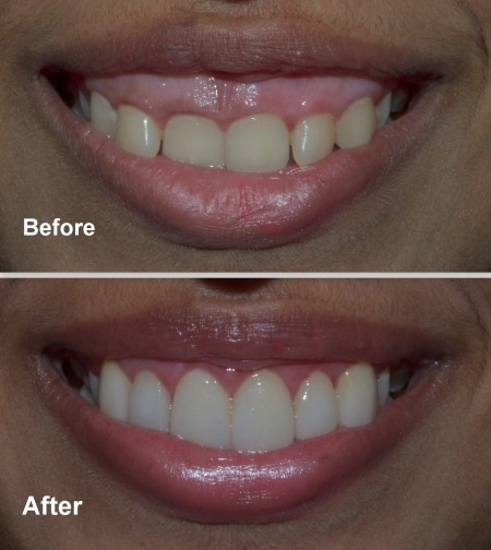 Teeth Implants Cost in India