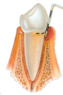 Mild Periodontis