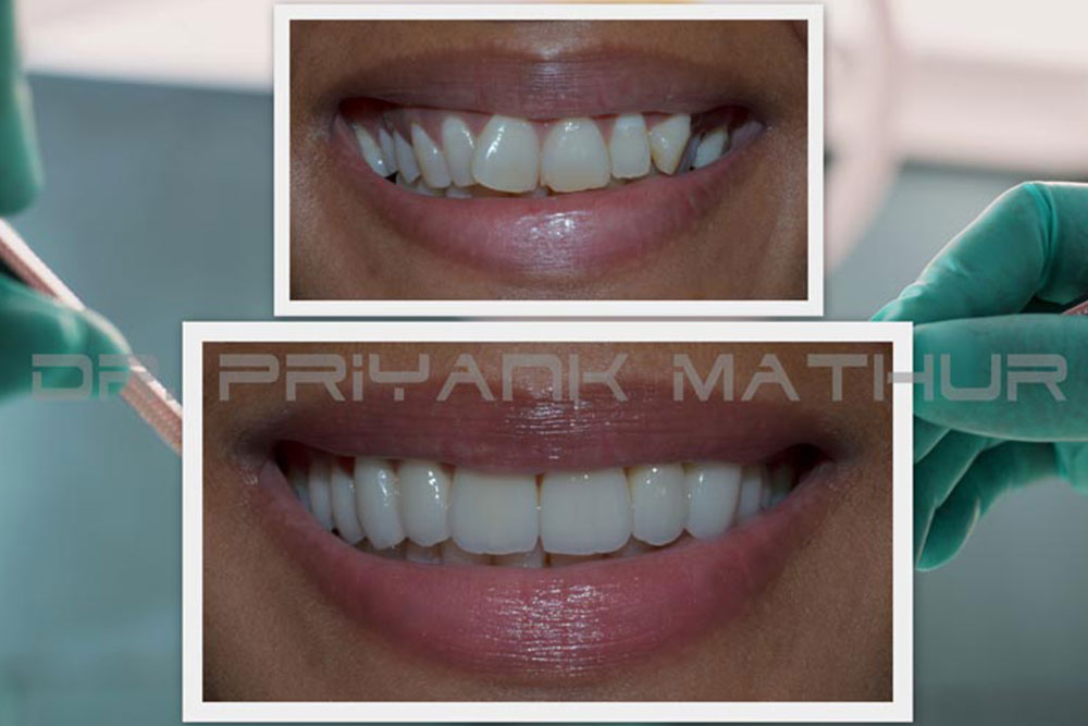 Emax Porcelain Crowns & Veneers Emax Porcelain Crowns & Veneers in India