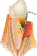 Severe Periodontis