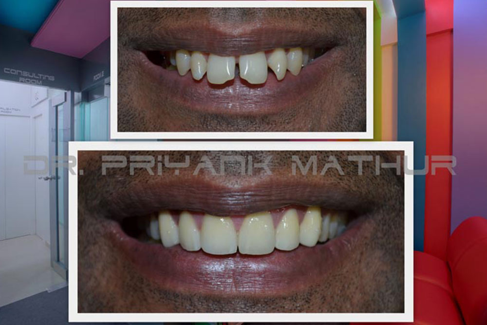 Smile-Correction Smile Correction