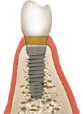 Adequate bone width regenerated for placement of a dental implant Adequate bone width regenerated for placement of a dental implant