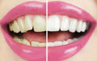Cosmetic Dentist in Pune India