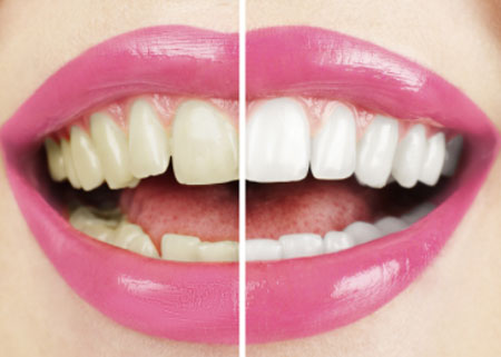 Cosmetic Dentist in Pune India