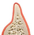 Inadequate bone width for successful implant placement Inadequate bone width for successful implant placement