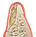Bone grafted on the deficient area and covered with a protective membrane Bone grafted on the deficient area and covered with a protective membrane