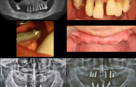 Deciduous Teeth