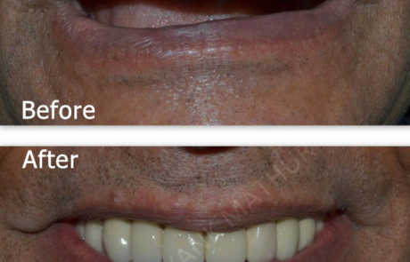 Full-Mouth Dental Implant Restorations