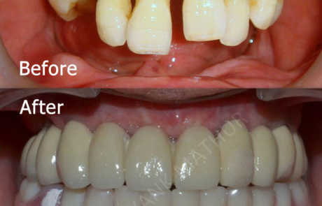 Full-Mouth Dental Implant Restorations
