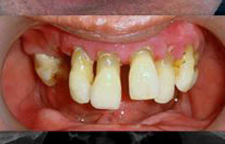 Full Mouth Dental Implant Restorations
