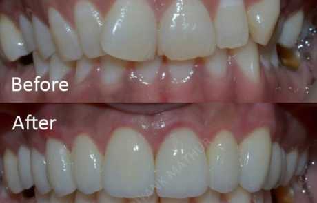 Smile Designing with Emax Crowns and Veneers