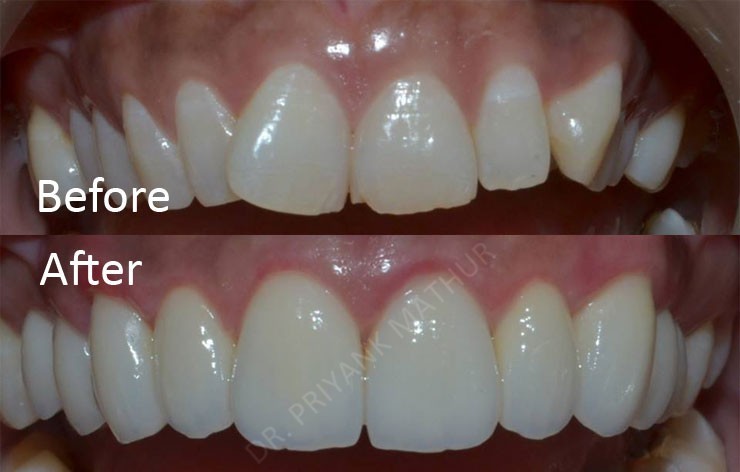 Smile Designing with Emax Crowns and Veneers