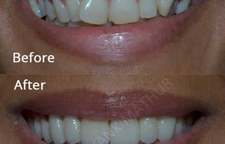 Smile Designing with Emax Crowns and Veneers