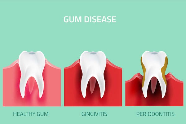 Gum Disease Treatment