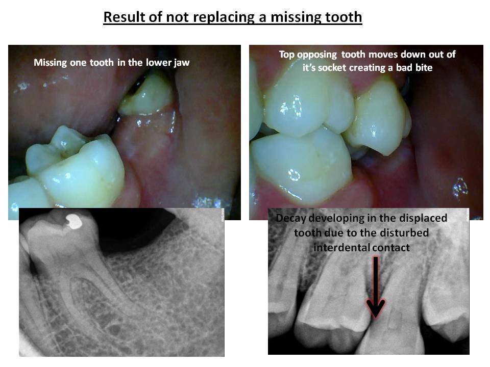 Restorative Dentistry in Pune Restorative Dentistry in Pune