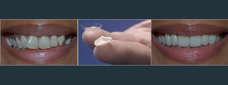 Porcelain Veneers Porcelain Veneers