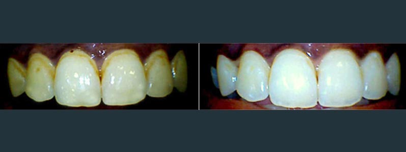 Teeth Whitening Pune Teeth Whitening in Pune