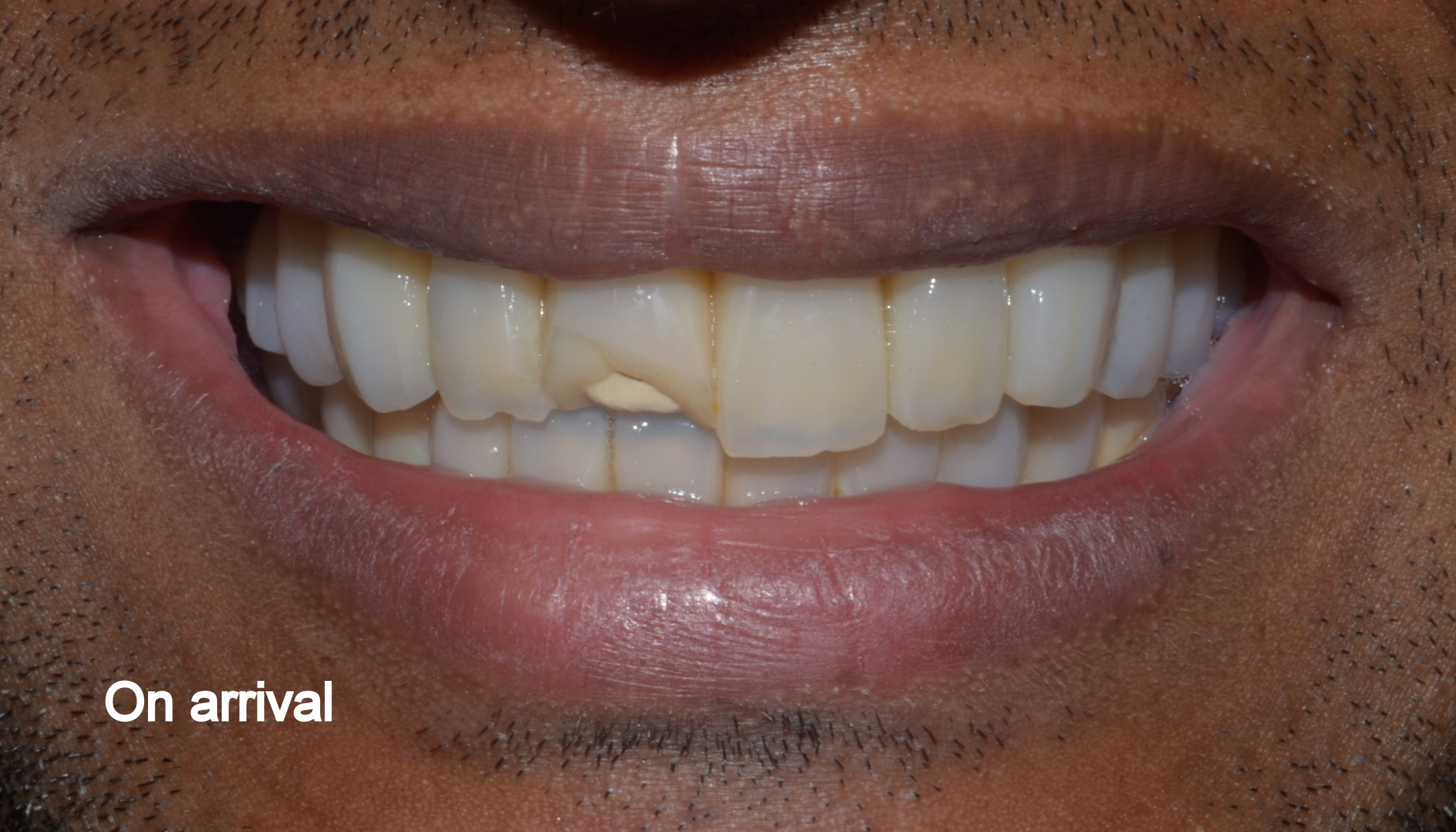 Implant Prosthesis Before Maintenance Implant Prosthesis Before Maintenance