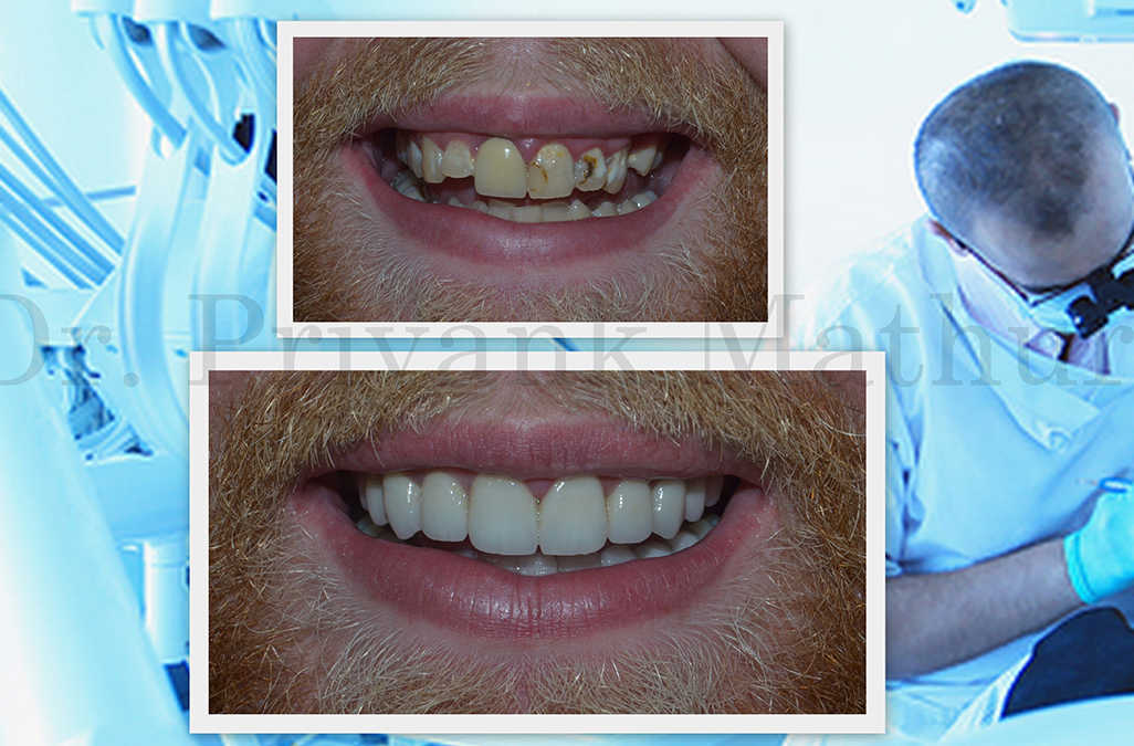 Smile Makeover Designing in Pune, India Smile makeover, smile designing in Pune, India