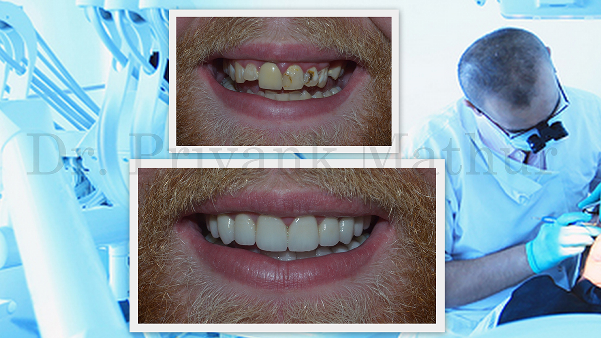 Smile Makeover Designing in Pune, India Smile Makeover Designing in Pune, India