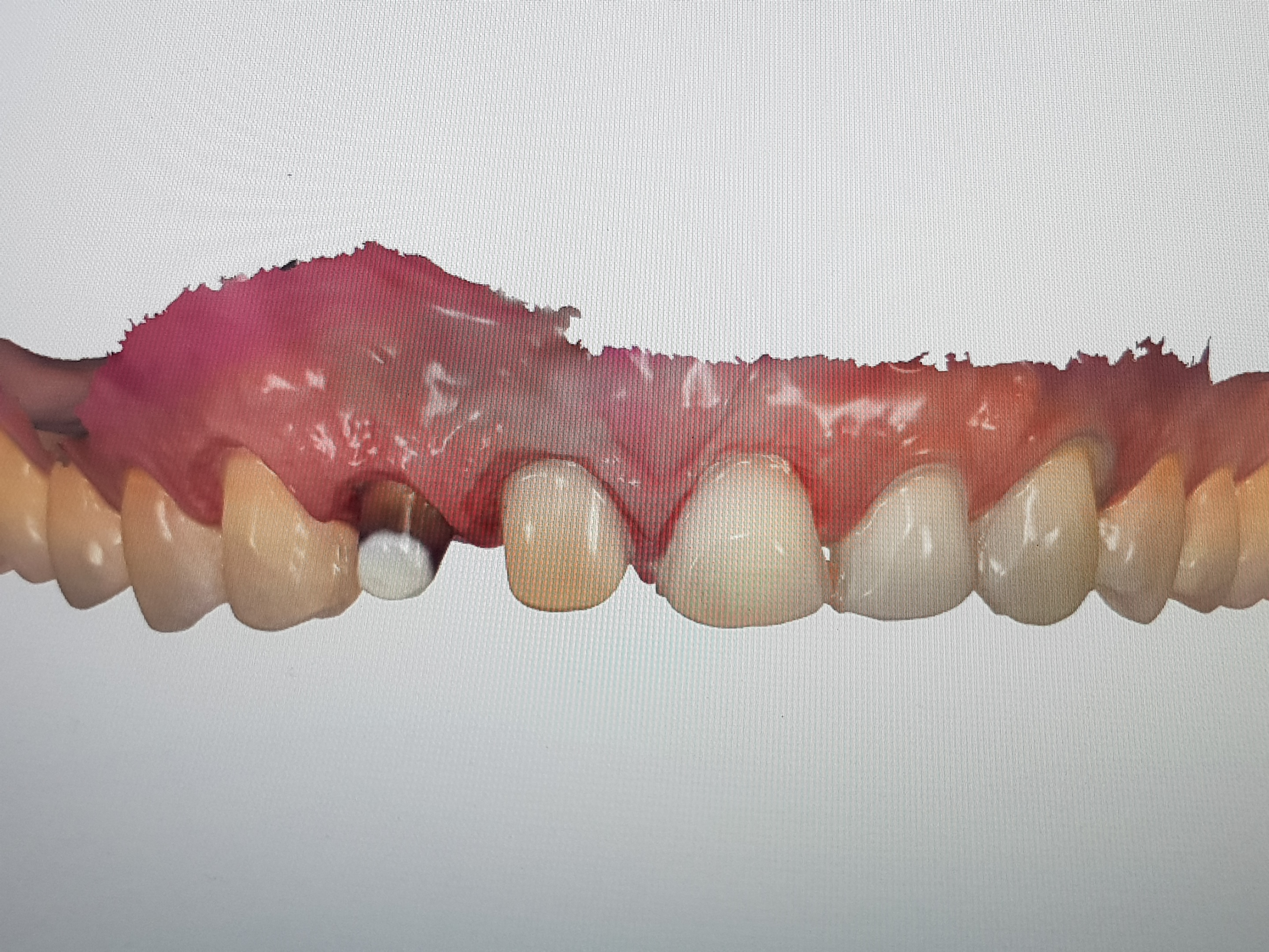 3D Digital scan digital dental treatment in Pune