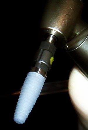 Dental Implant in Pune Dental implant in Pune