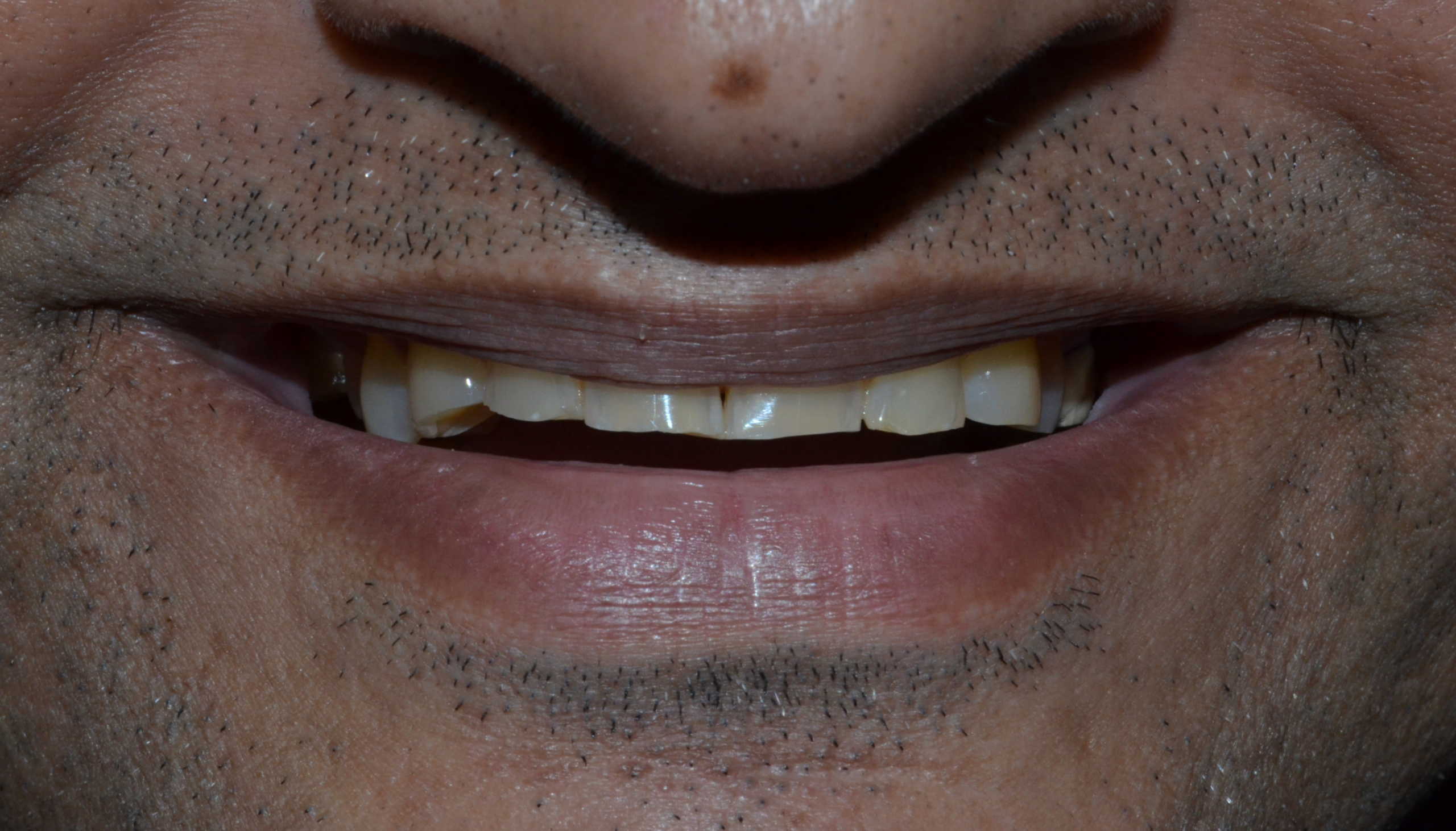 before full mouth rehab