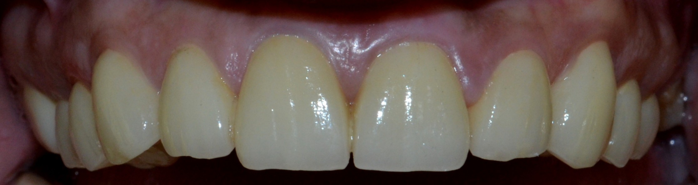 Final Top Teeth