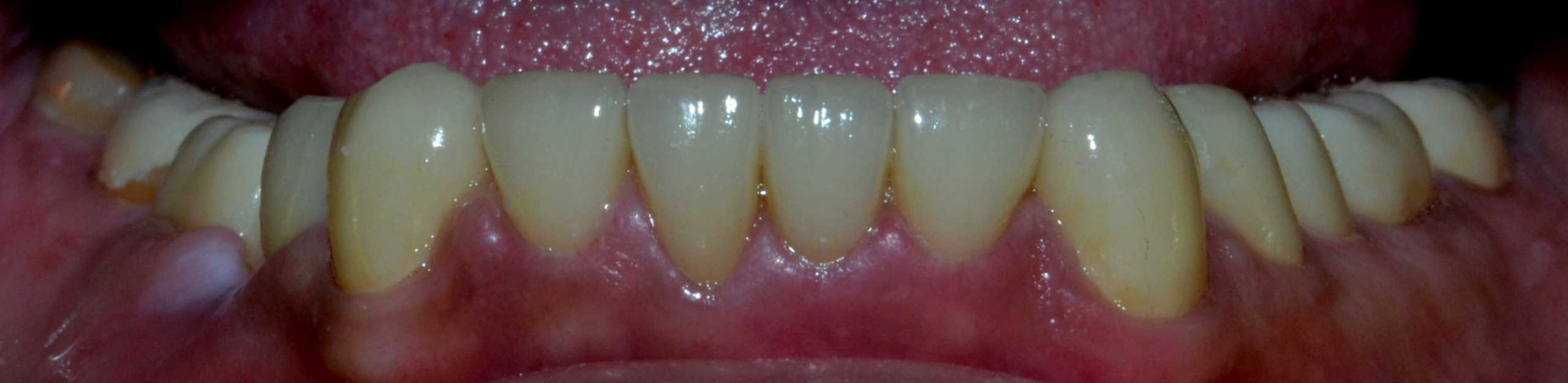 Final Lower teeth