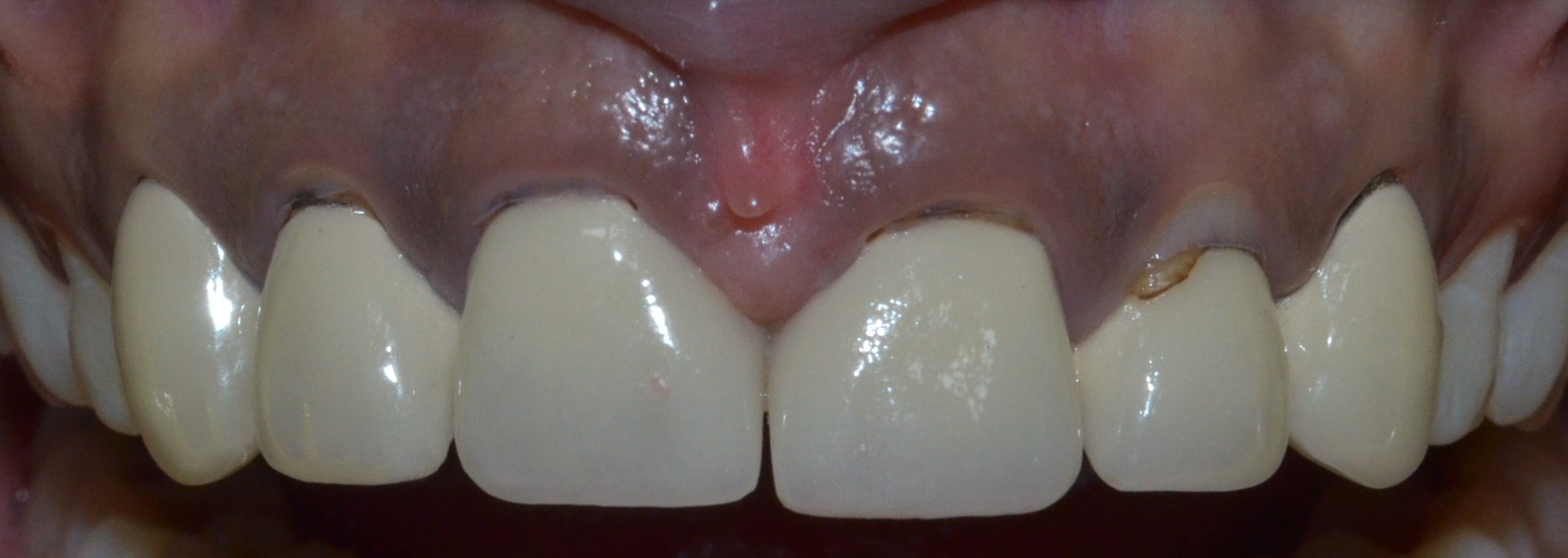 Old PFM crowns