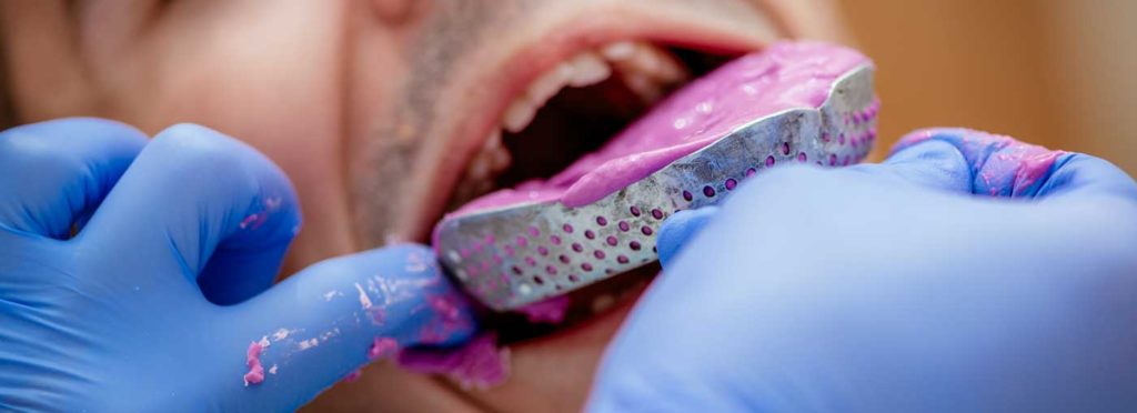 Conventional dental impression Conventional dental impression