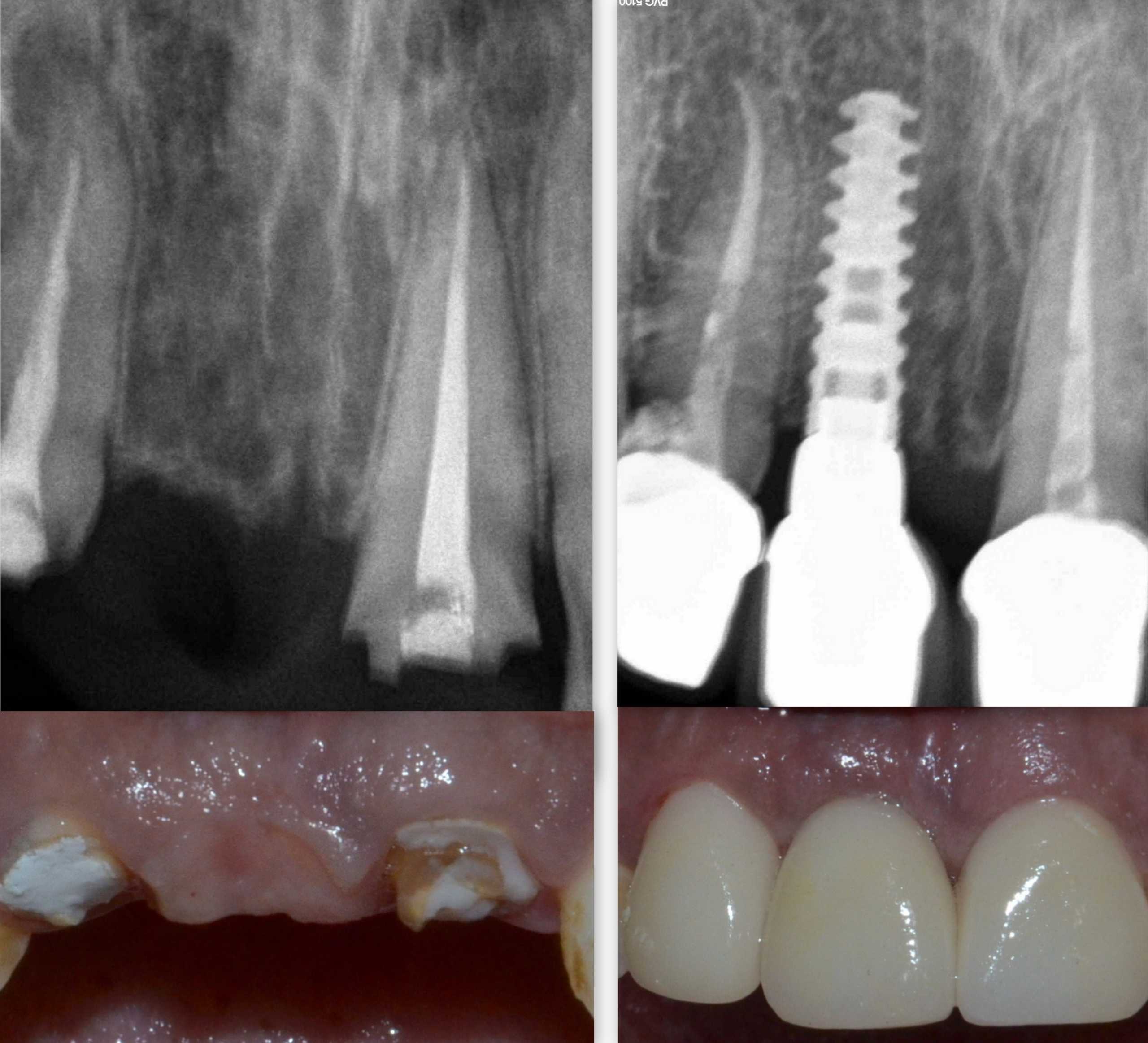 dental implant in Pune Dental implant in Pune