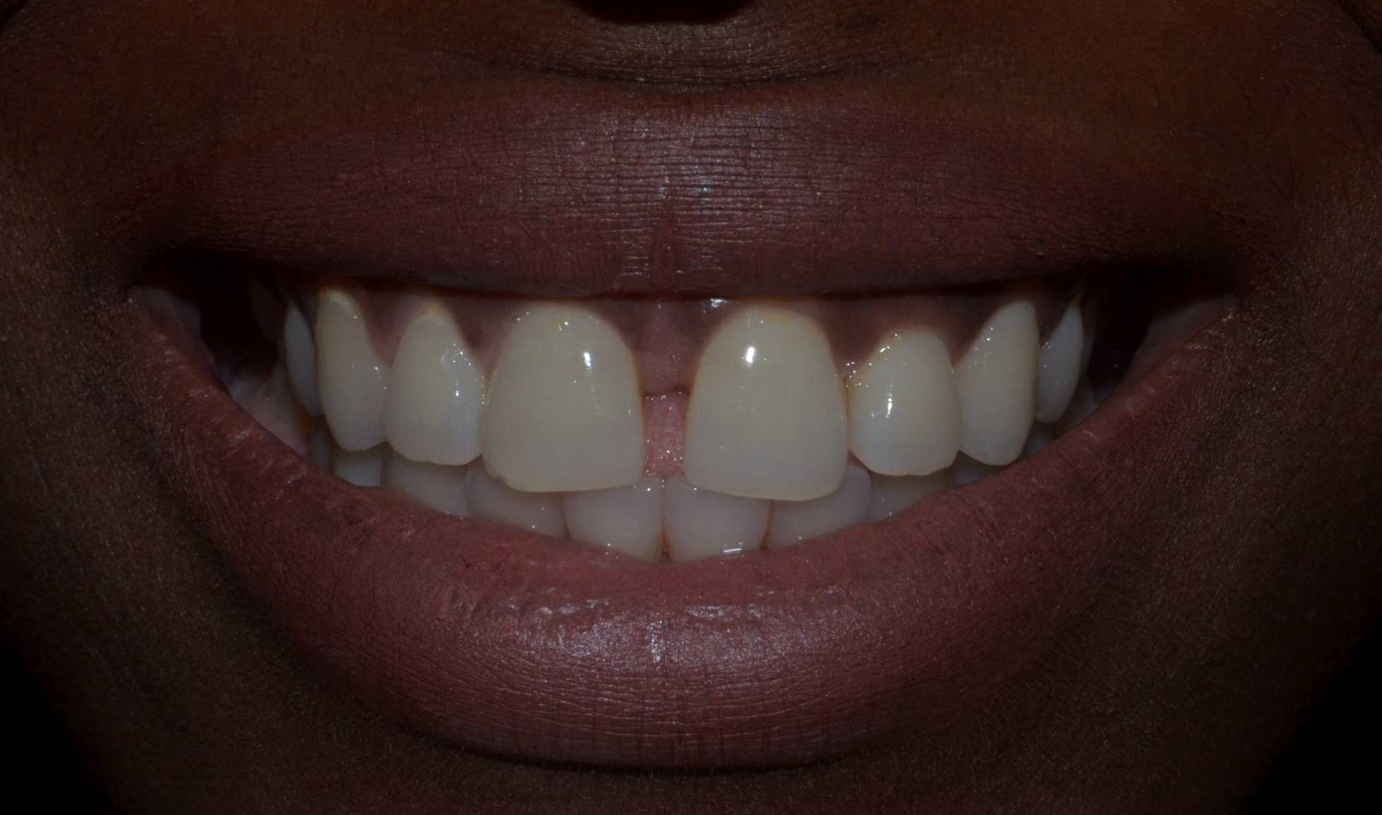 Midline diastema