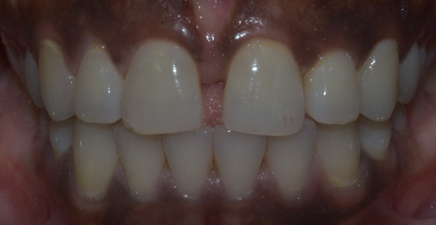 midline diastema intra oral picture