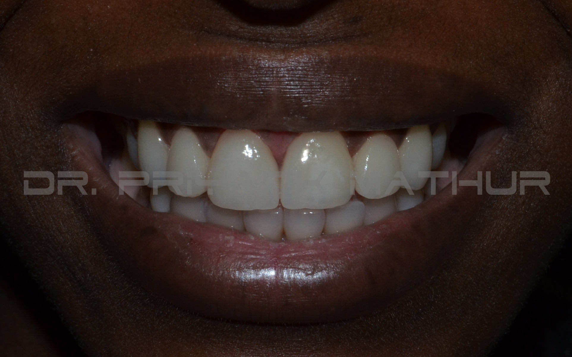 After treatment with porcelain veneers