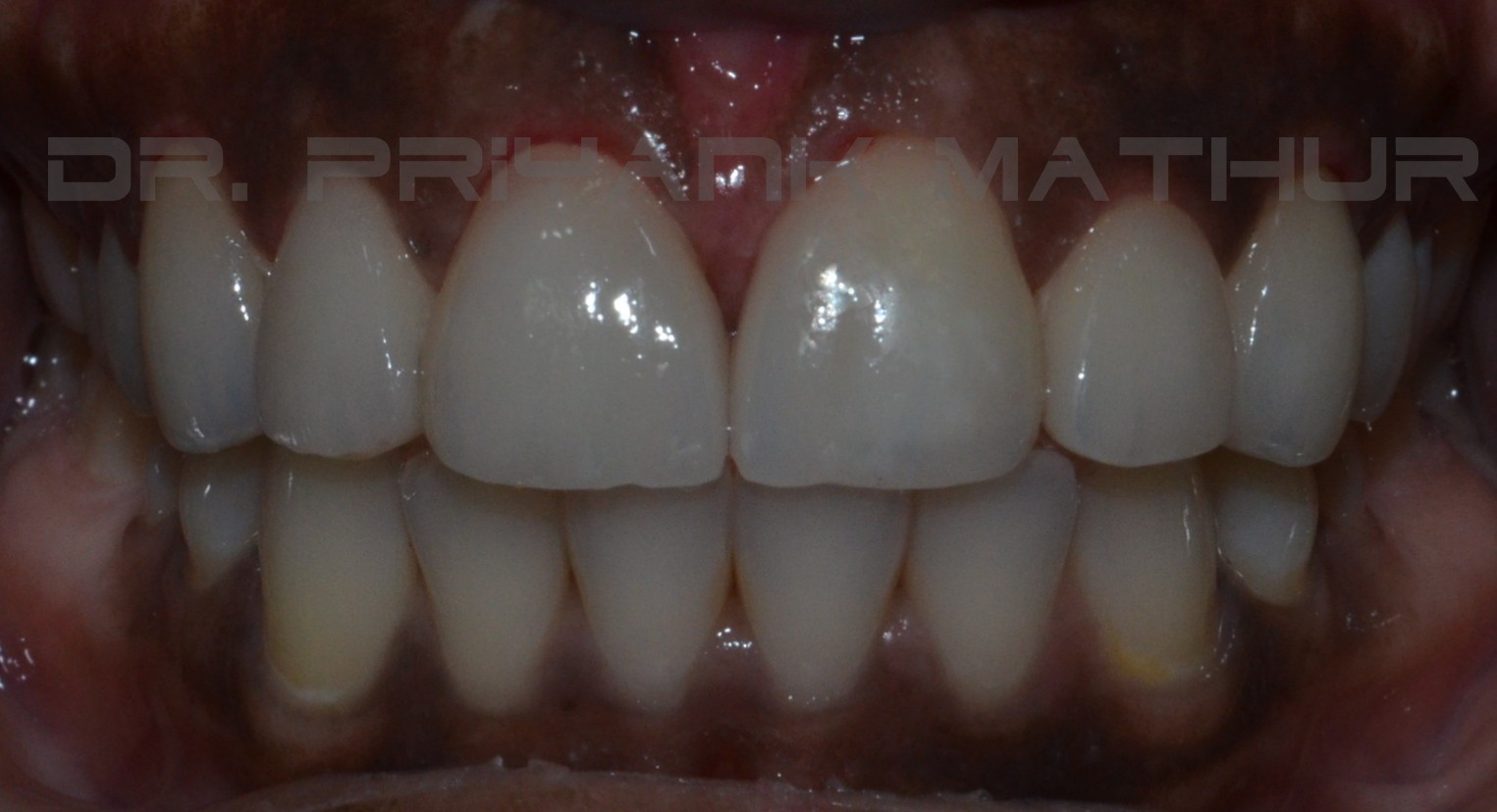 After treating the midline diastema