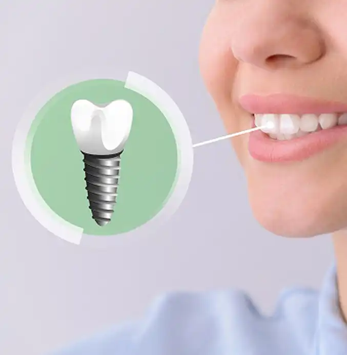 dental-implants