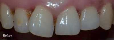Before