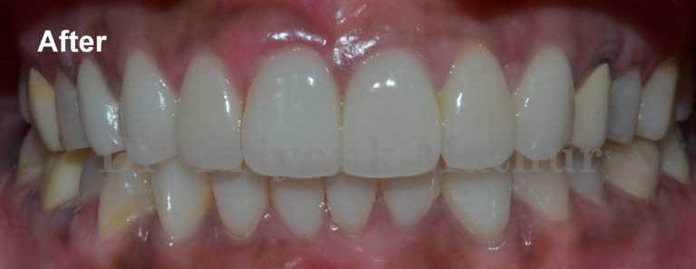 After