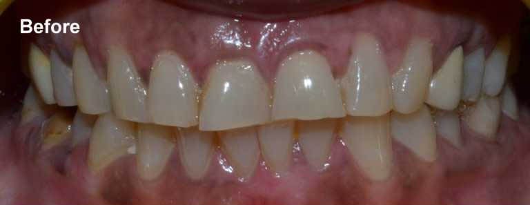 Before