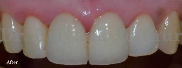After