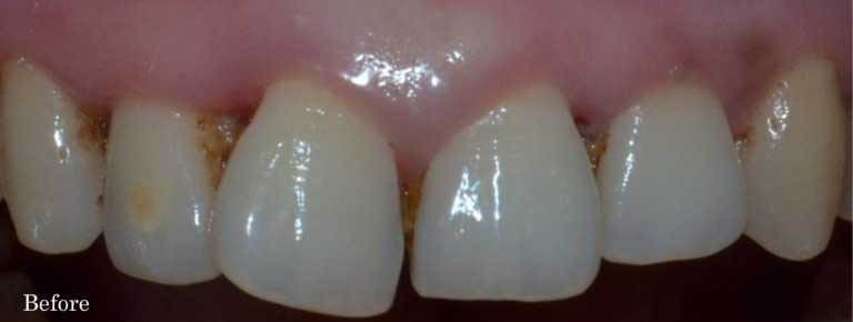 Before