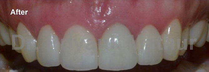 After